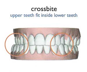What was P thinking, developing teeth like this? Kids these days.
